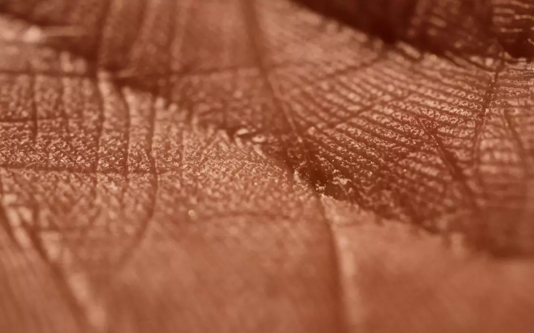 Alles &uuml;ber Besenreiser: Was Sie wissen m&uuml;ssen