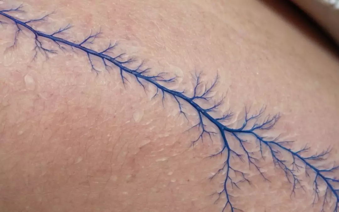 Thrombose am Bein: Symptome und Behandlung verstehen