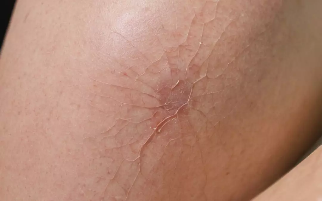 Besenreiser effektiv und sicher entfernen