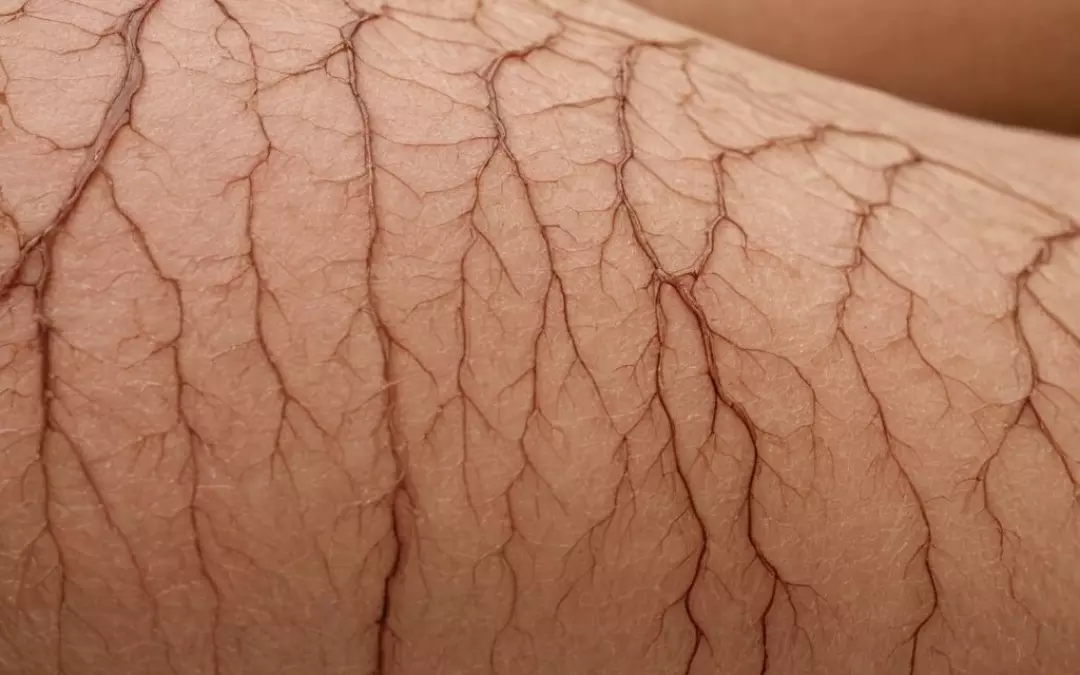 Krampfadern selbst entfernen: Effektive Methoden und Tipps