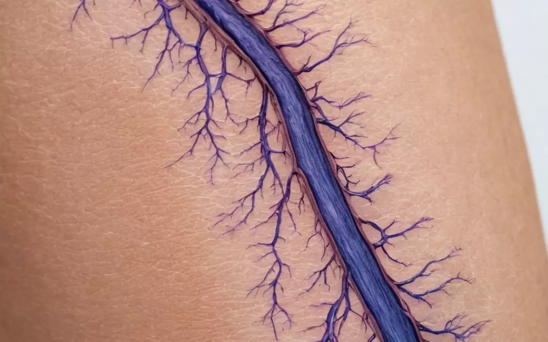 Effektive Methoden zum Krampfadern Entfernen: Ein &Uuml;berblick