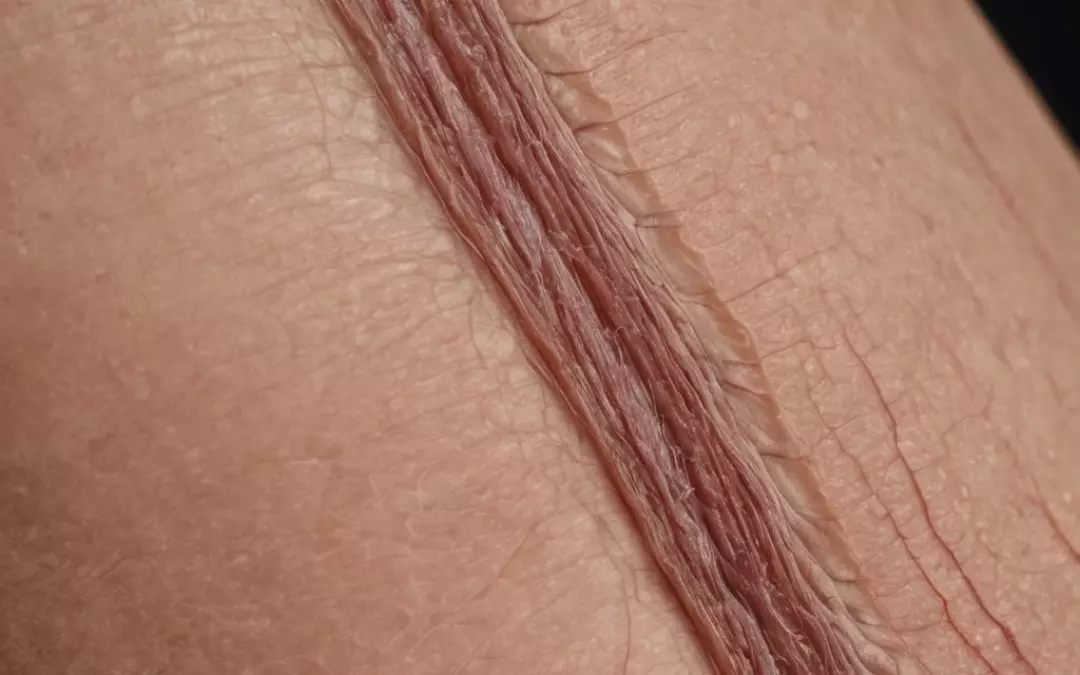 Krampfadern behandeln lassen: Ein umfassender Leitfaden