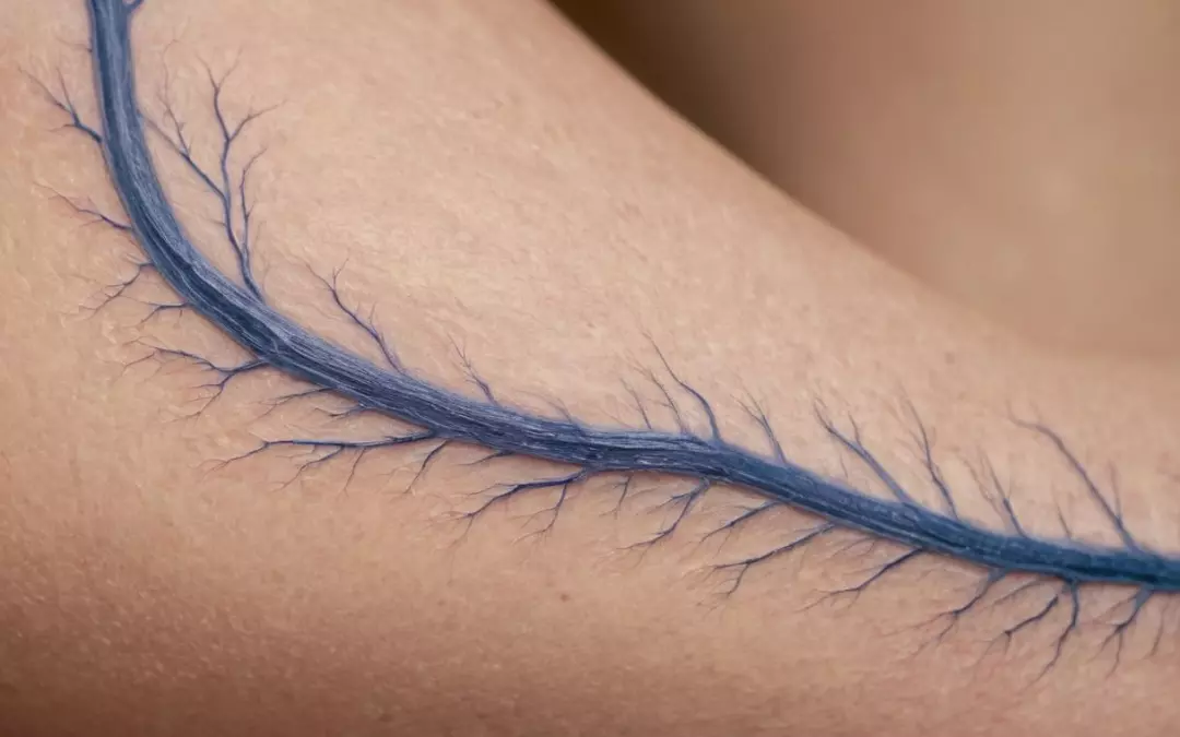 Arzt Krampfadern: Behandlung und Vorbeugung