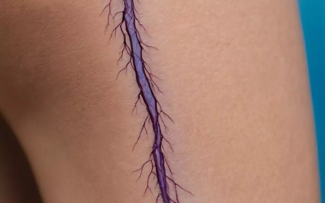 Verst&auml;ndnis der Krampfadern Vorstufe und ihre Symptome