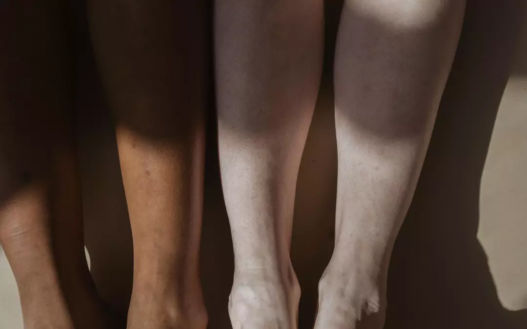 Dicke Beine durch Venenschw&auml;che: Ursachen und L&ouml;sungen