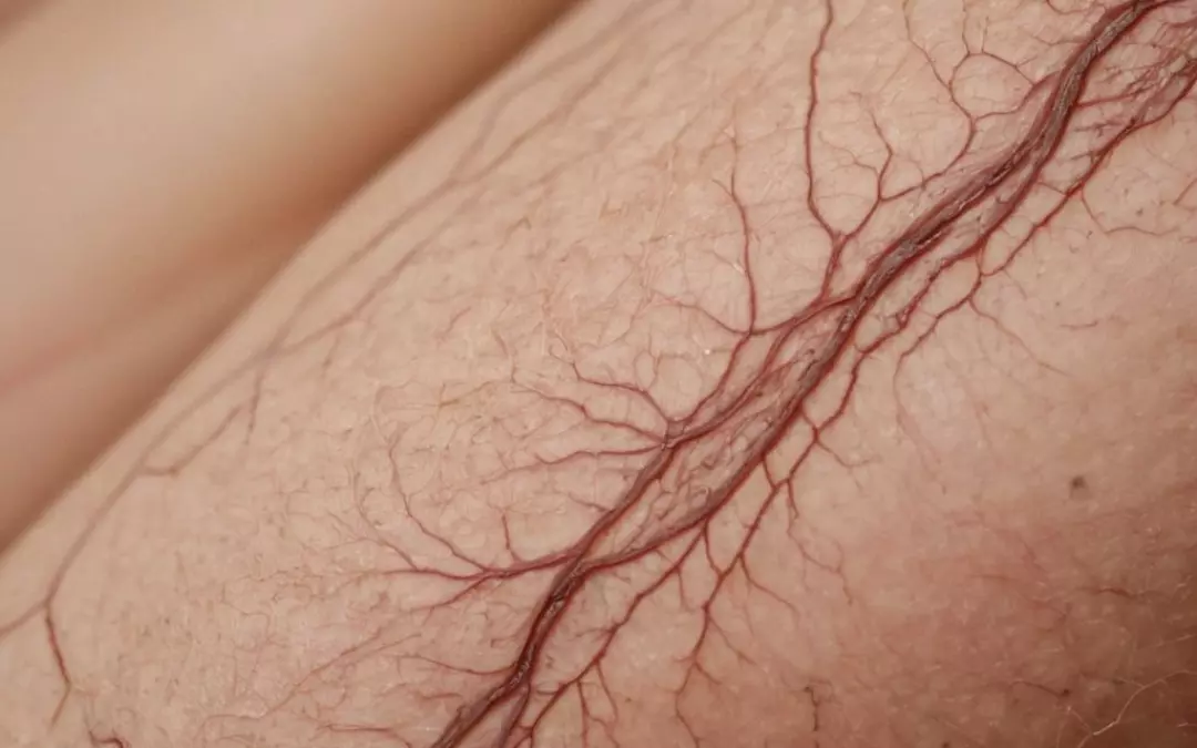 Effektive Methoden zum Entfernen dicker Krampfadern