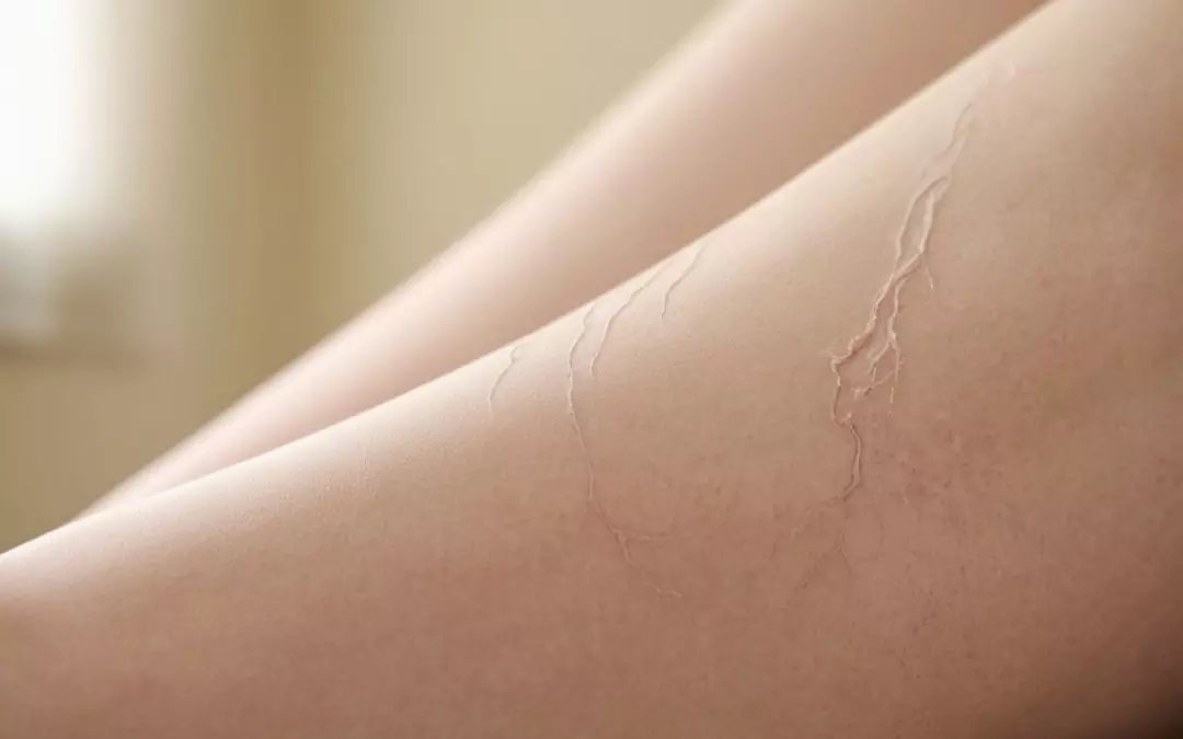 Jucken Krampfadern: Was Sie wissen m&uuml;ssen