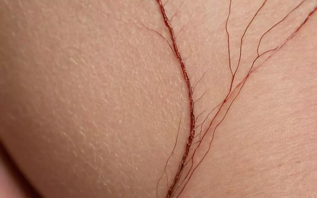 Besenreiser Ultraschall entfernen: Effektive L&ouml;sungen