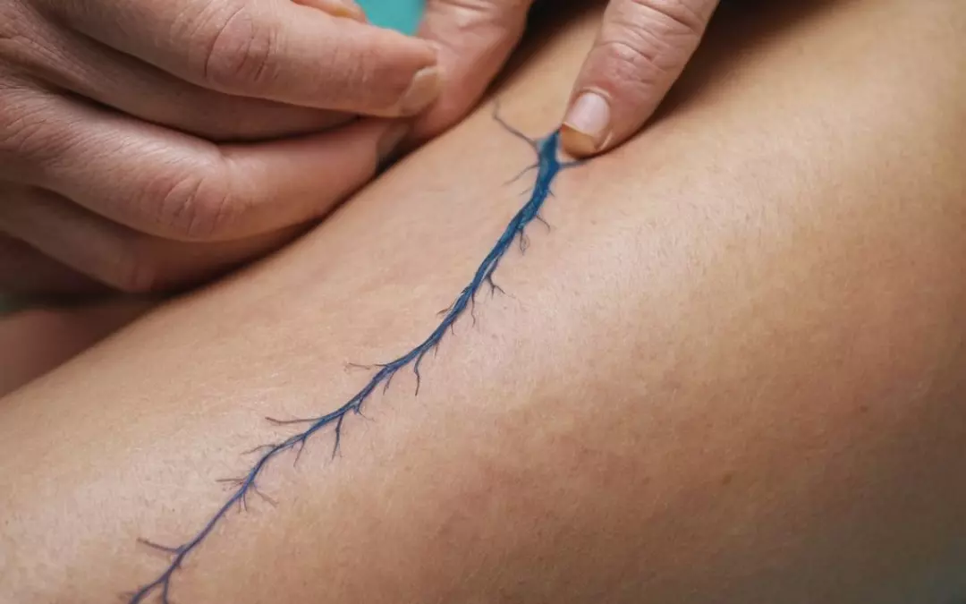 Kosten f&uuml;r Krampfadern entfernen in der Schweiz