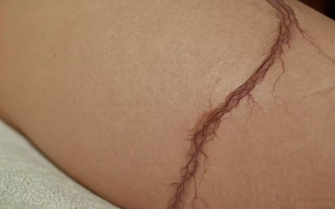 Krampfadern R&uuml;ckbildung: Alles, was Sie wissen m&uuml;ssen